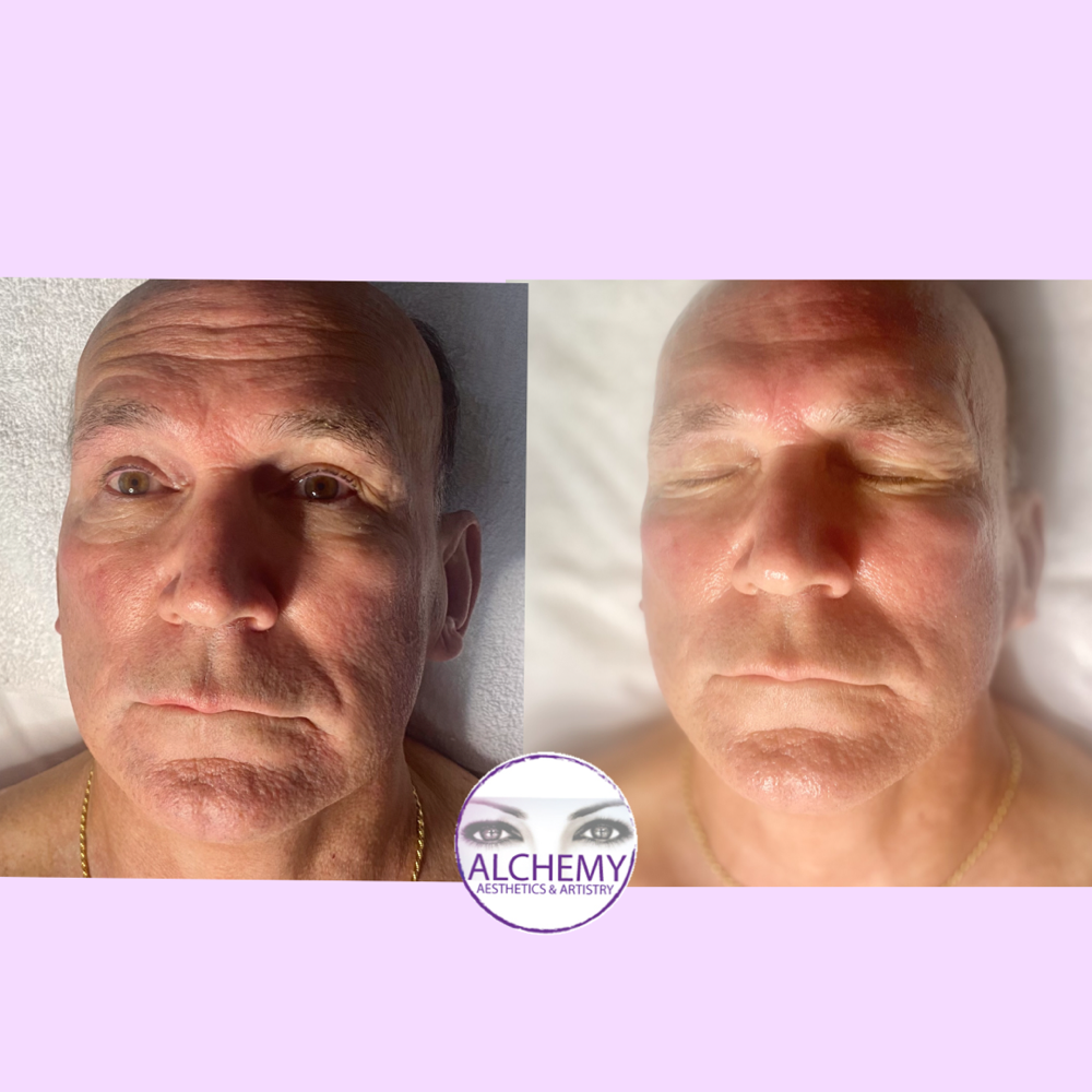 Nonsurgical Facelift (facial)