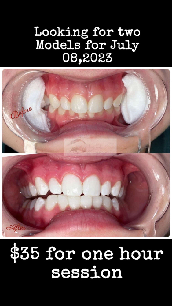 Teeth Whitening