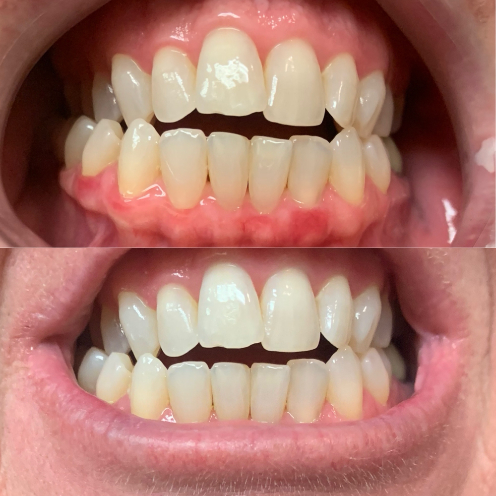 Teeth Whitening At Home Kit at Lovely Airbrush Tanning Co. in Cape Canaveral, FL