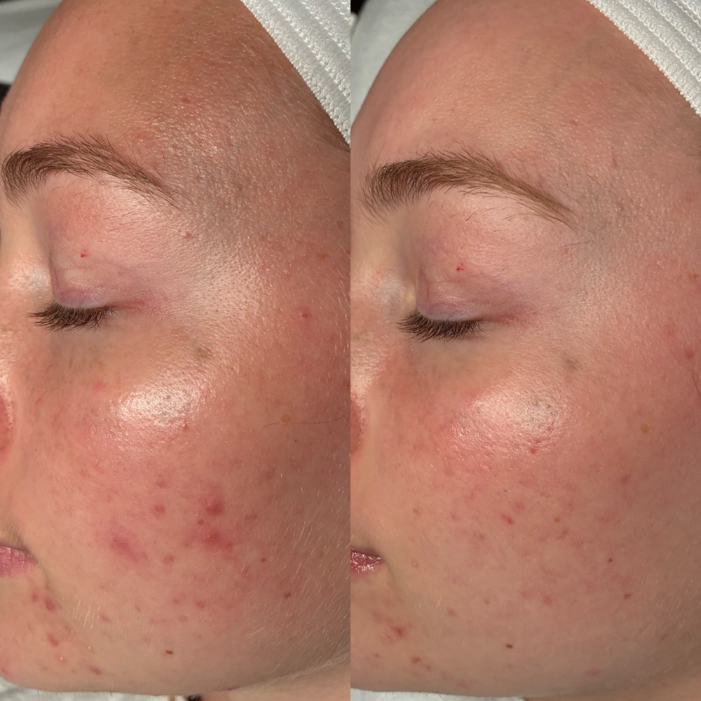 Acne Bootcamp Consult + 1st Trt at Sunday Skincare in Las Vegas, NV