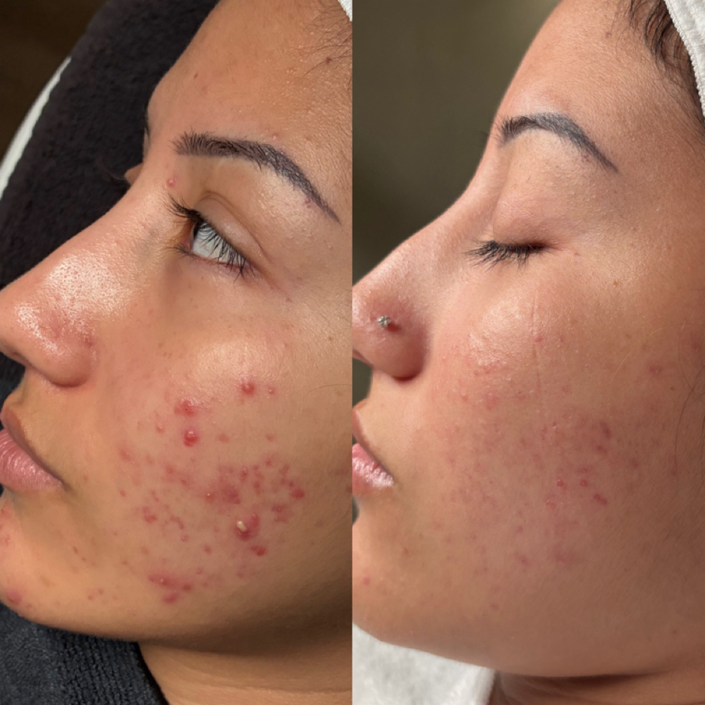Acne Bootcamp Consult + 1st Trt at Sunday Skincare in Las Vegas, NV