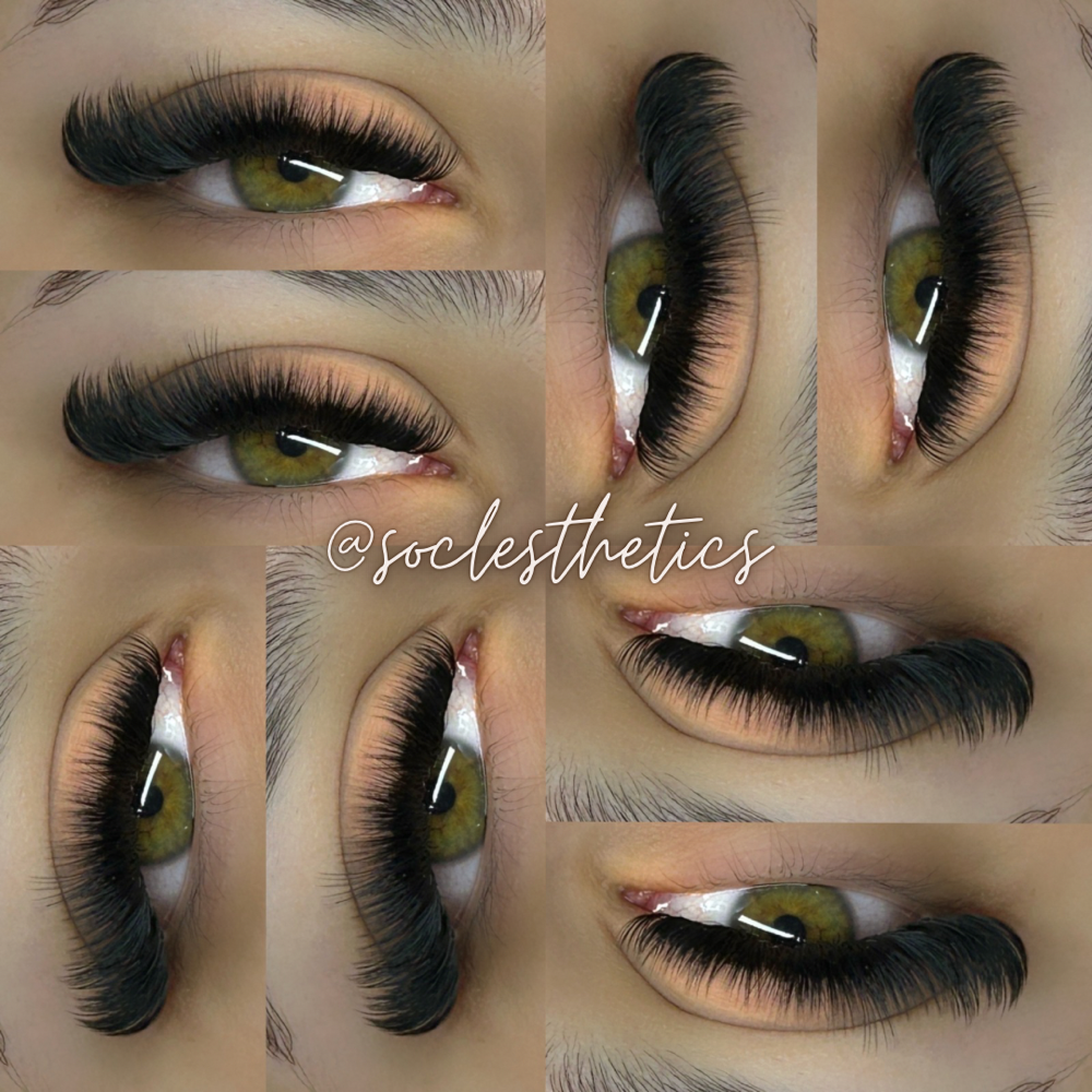 Volume Fill at SOCL Esthetics in Indianapolis, IN