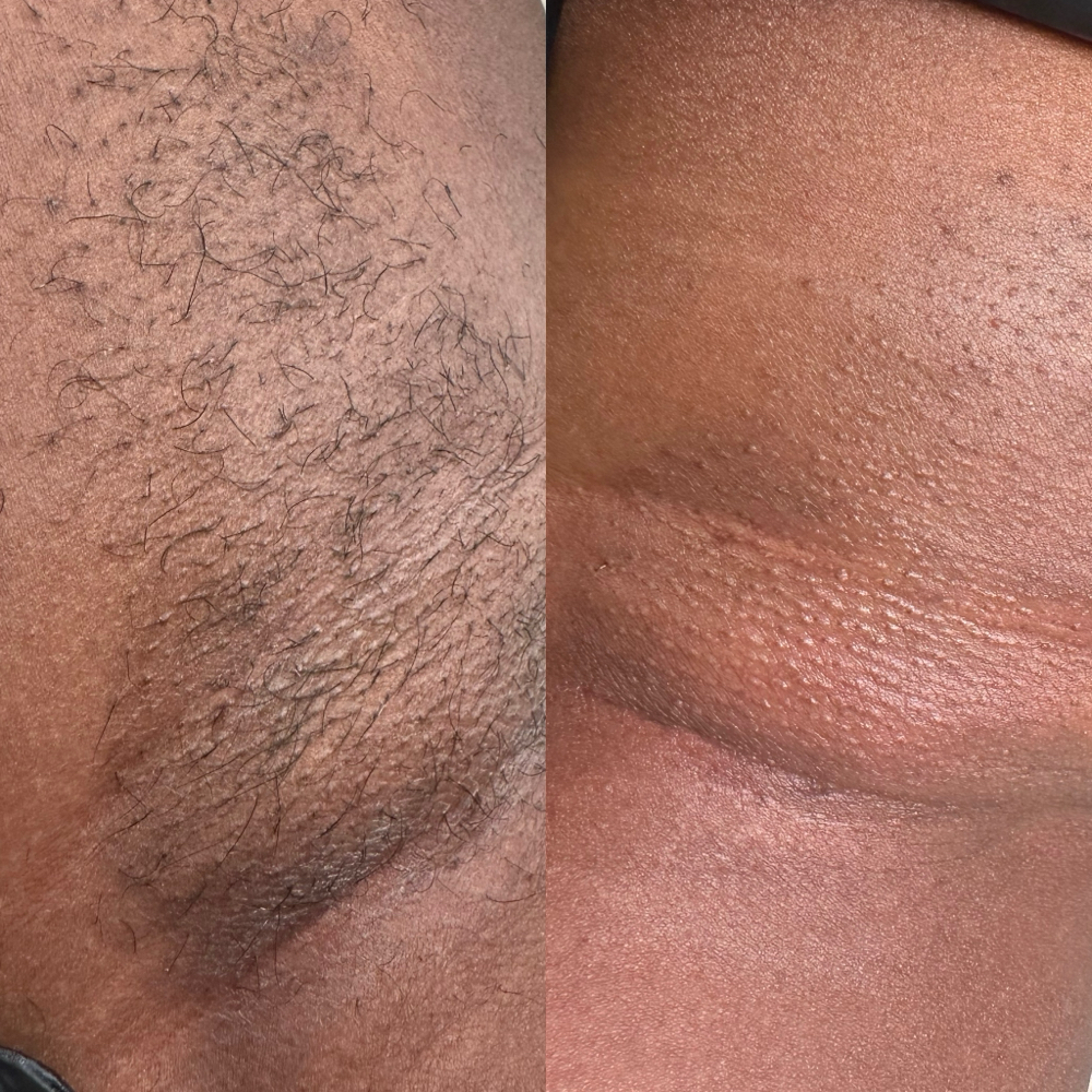 Underarm wax at J Esthetics in Homewood, IL