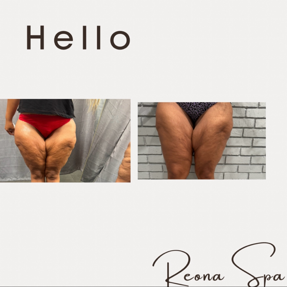 3 Cellulite Treatment at Reona Spa in Gretna, LA