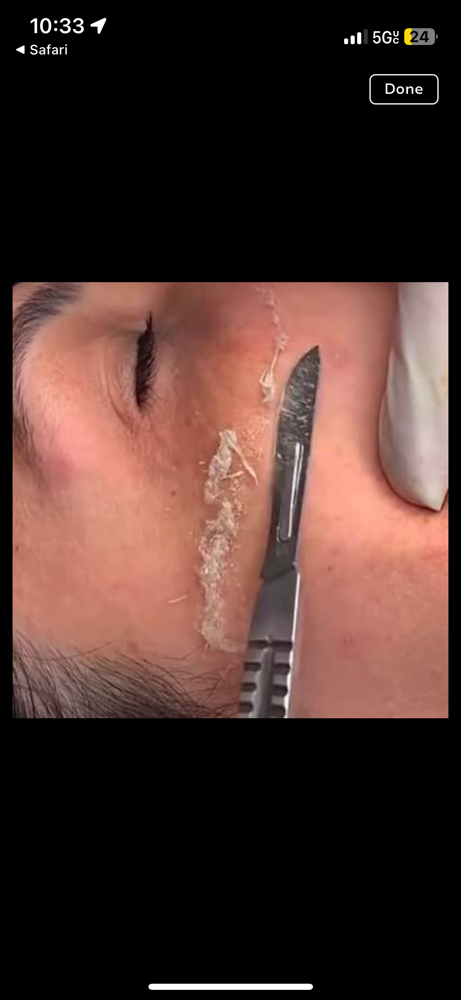 Dermaplaning Facial
