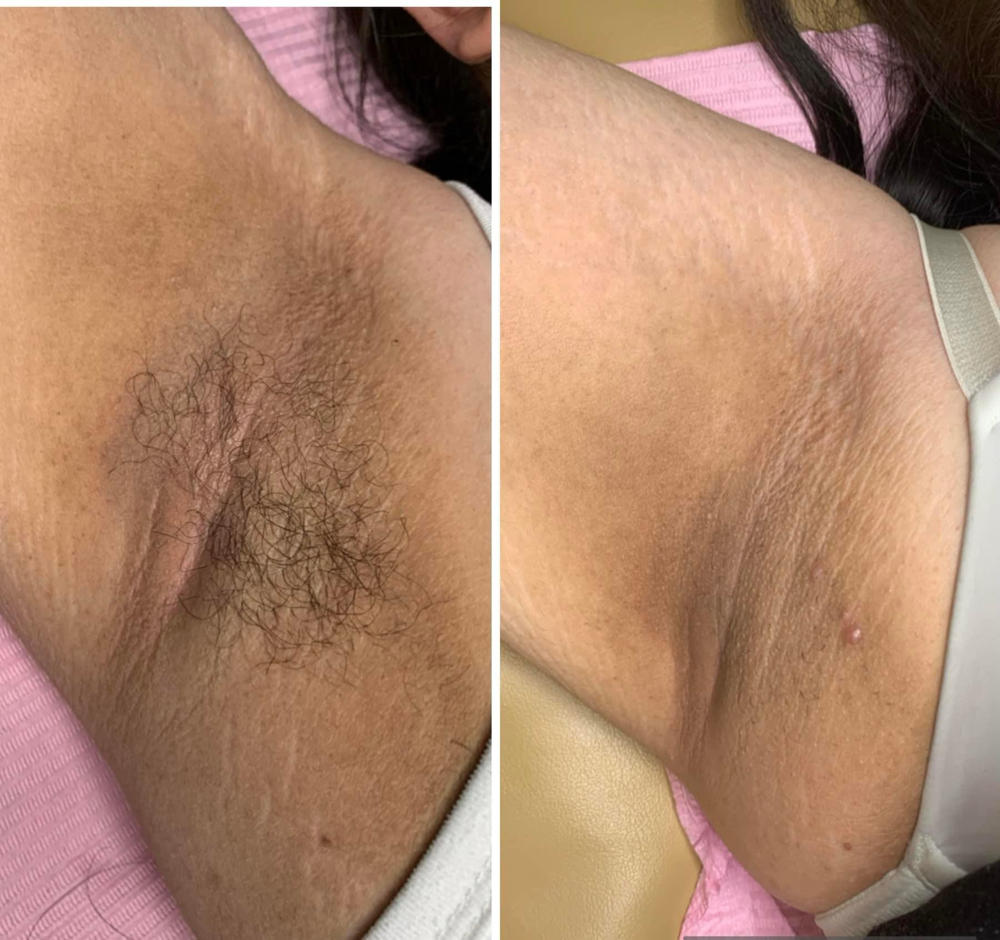 Underarm wax