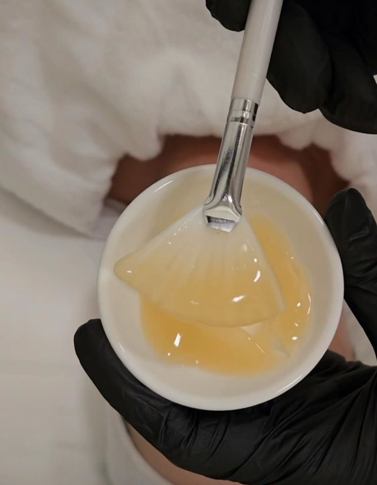 Chemical Peel at Aleyari Beauty in Everett, WA