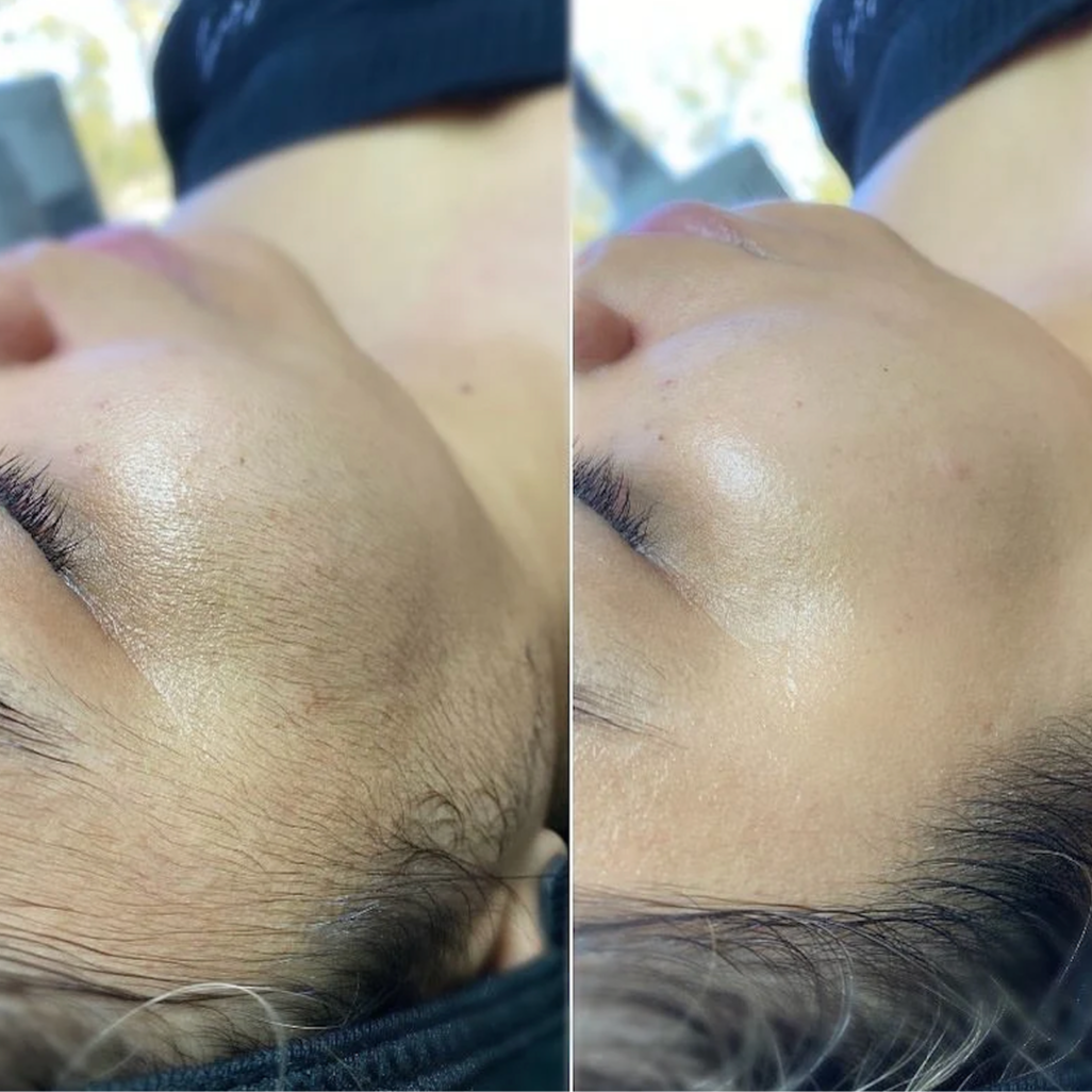 Dermaplane Peel at Piper K Skin Care in Peoria, IL