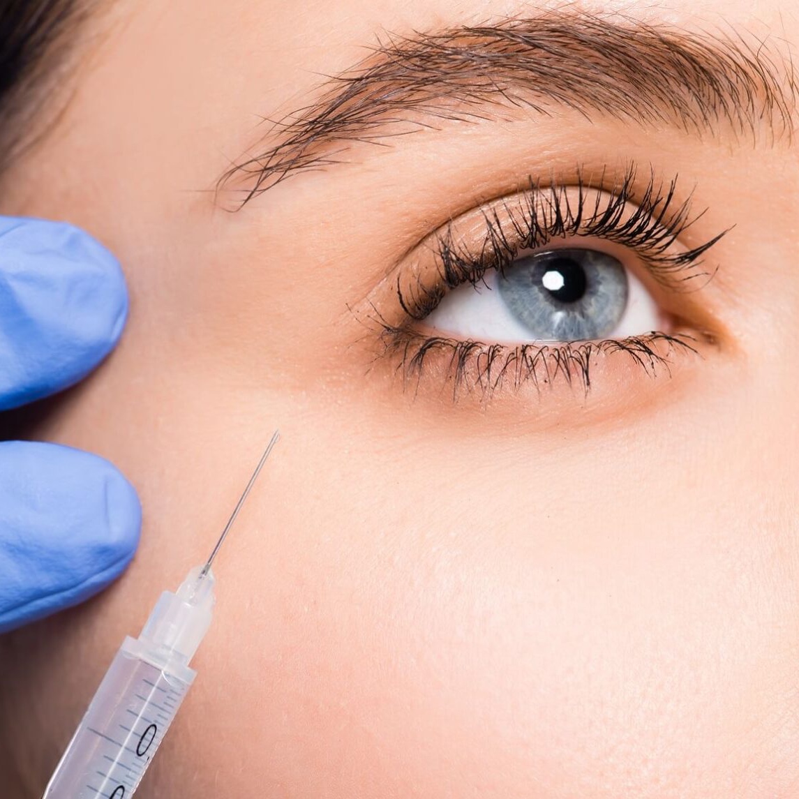 Under Eye Filler at Athena Med Spa in San Antonio, TX