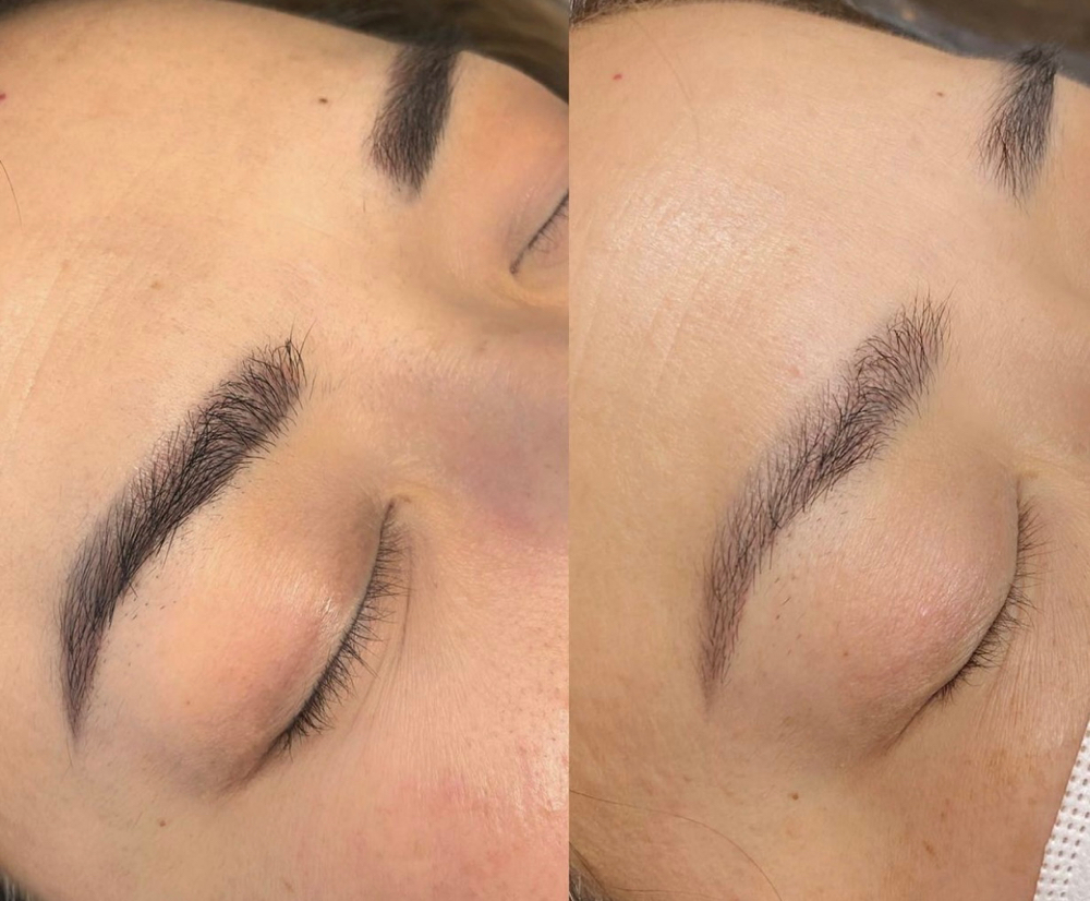 Li-ft Saline Removal Per Session