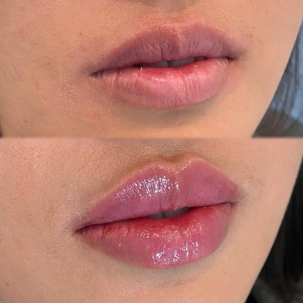 HydraLips - 1 Session Only