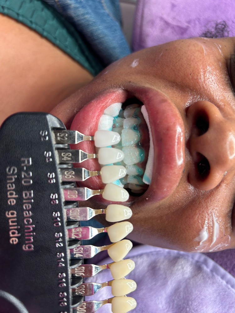 Teeth Whitening 1hour