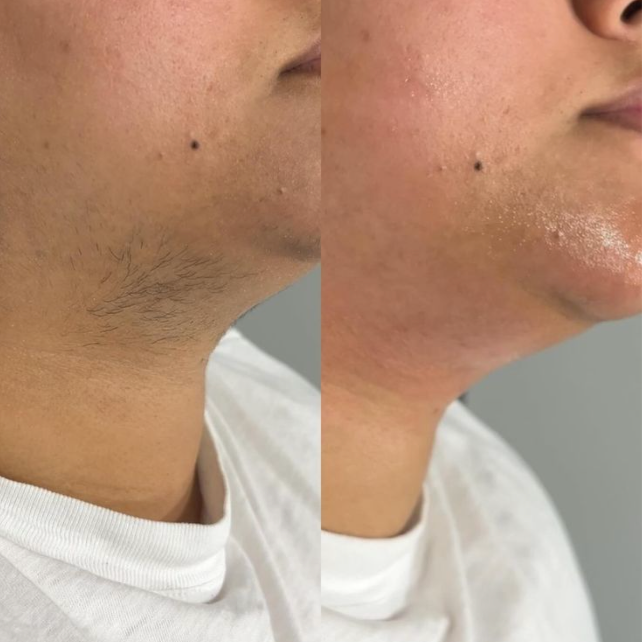 Chin Wax at Refinery Aesthetics Loft in Oxon Hill, MD