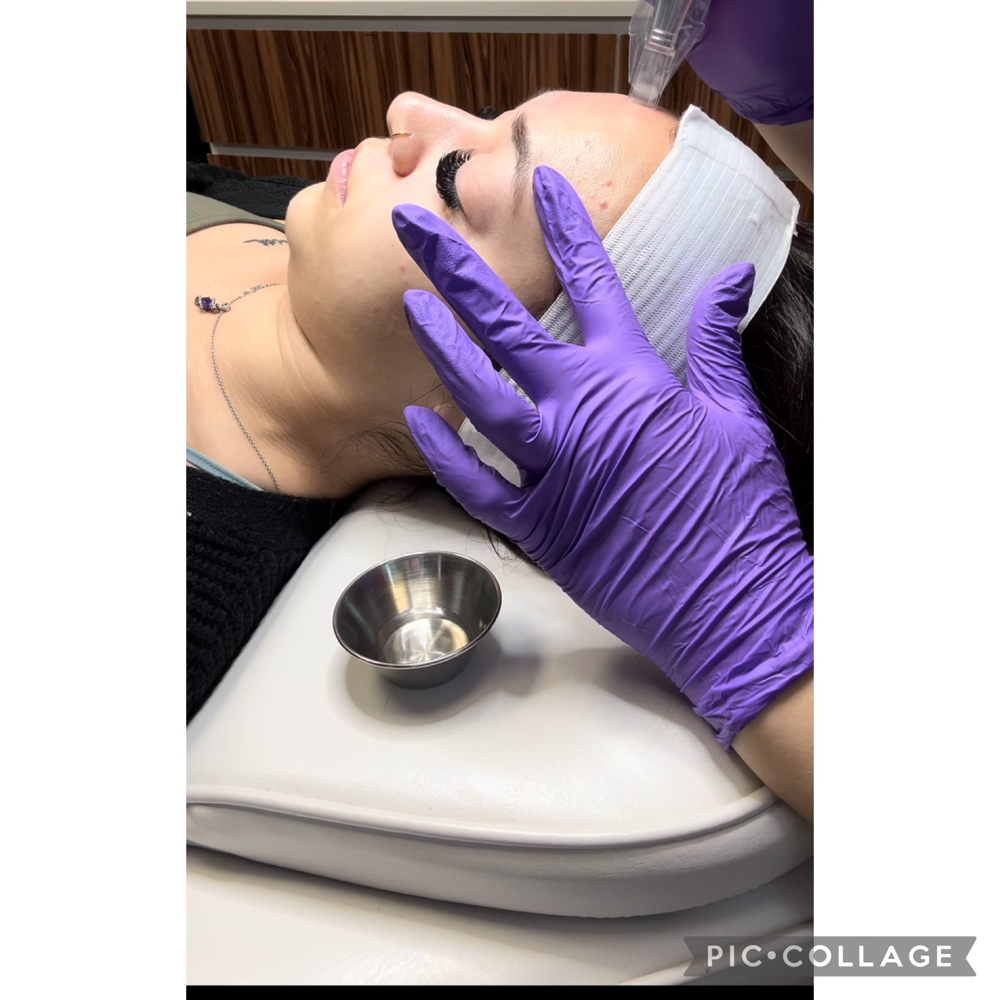 Microneedling