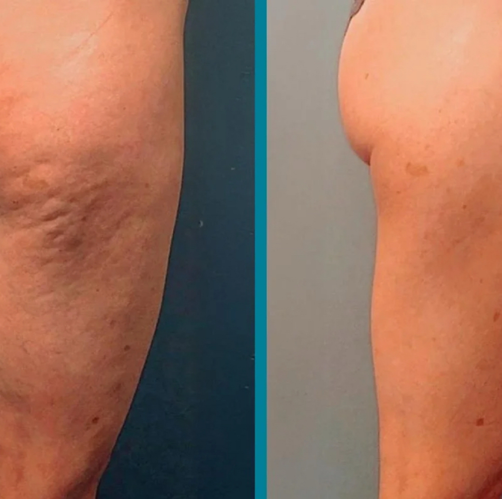 2D RF Skin Tightening at Luminous Beauty Studio in Gillette, WY