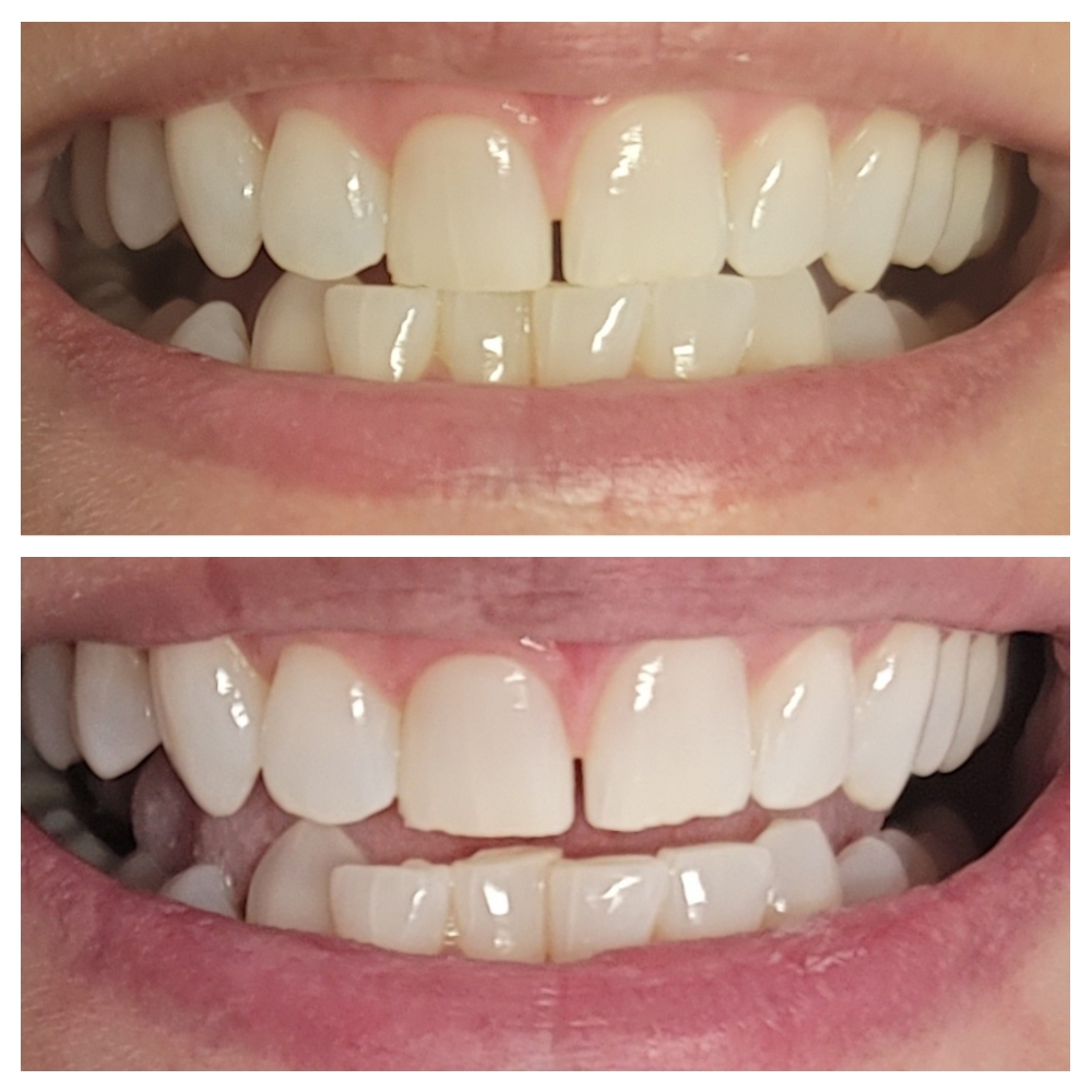 30 minute teeth whitening