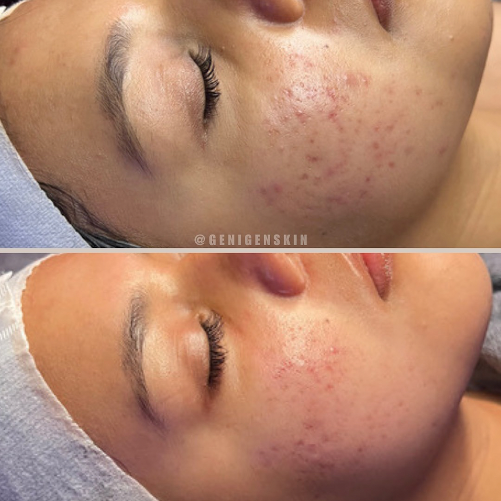 Acne Bootcamp -First Session