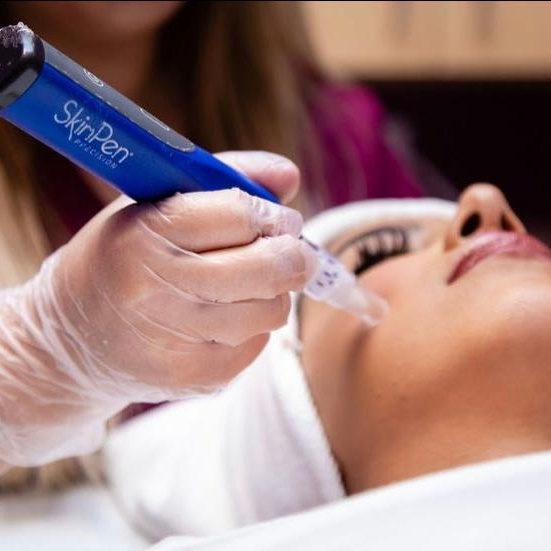 SkinPen Microneedling - Face at BLUSH Aesthetics LLC in Laredo, TX