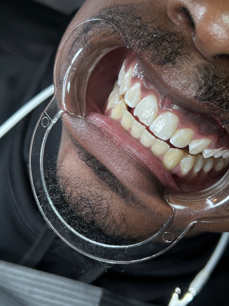 Regular Whitening