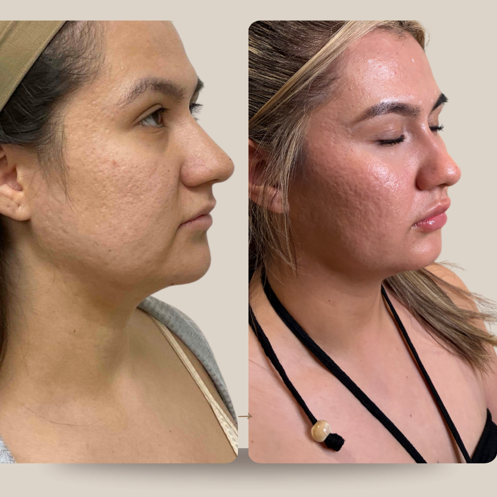 Microneedling with PRP