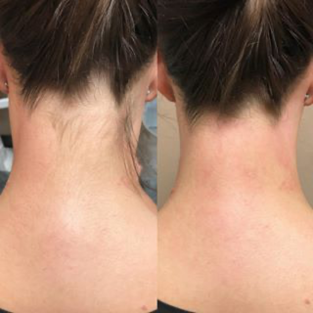 Neck Hairline at Thread’in Shape & Spa in Yardley, PA