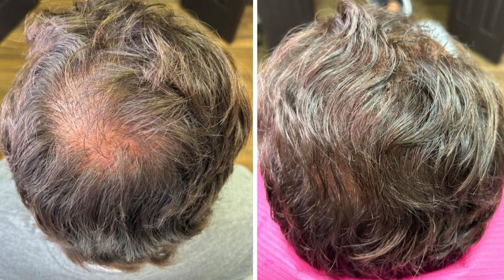Procell Hair Restoration