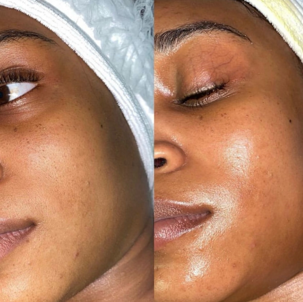 Dermaplaning Facial