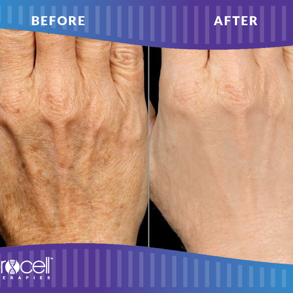 Chrysalis + ProCell Hand Treatment at Estetica in Venice, FL
