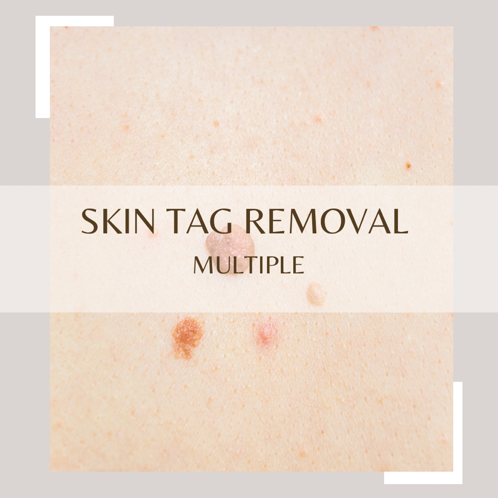 Skin Tag Removal