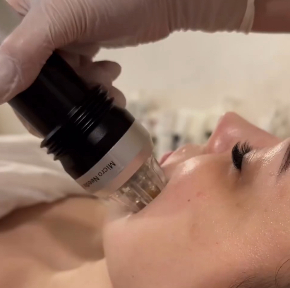 Fractional microneedling RF lifting