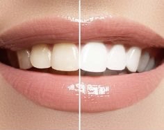 TEETH WHITENING (3 SESSIONS)