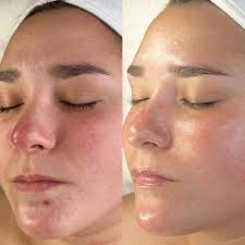 Glymed Peptide Peel No Dermaplane