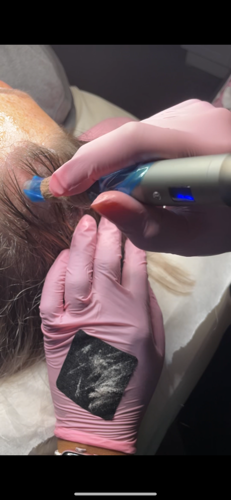 Scalp Microneedling