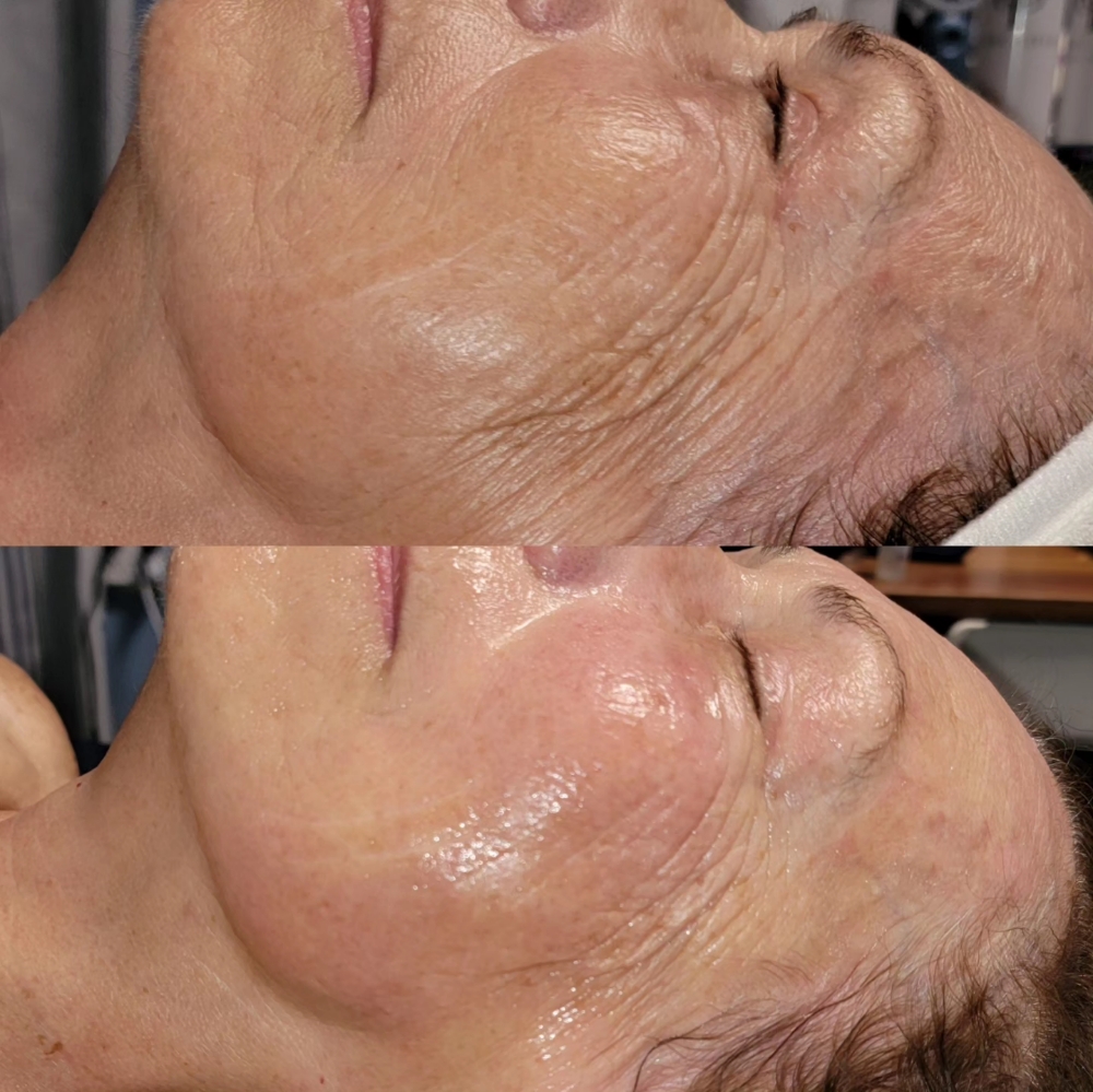 Advanced Skin Rejuvenation