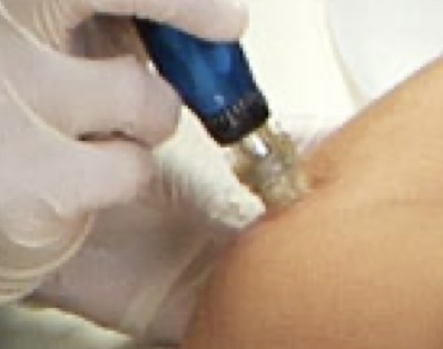 Micro Needling