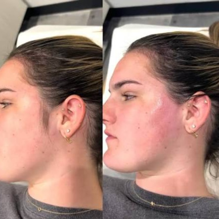 Side Burns at Beyond Aesthetics in Westport, MA