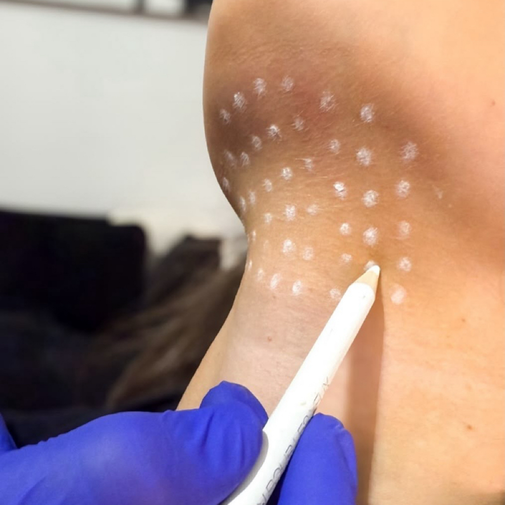 Submental Area Liquid Lipo at Rein Aesthetics & Wellness in Alice, TX