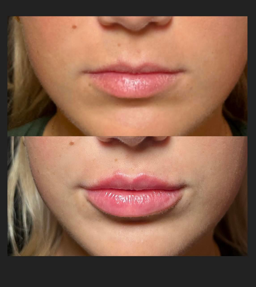 Lip Filler