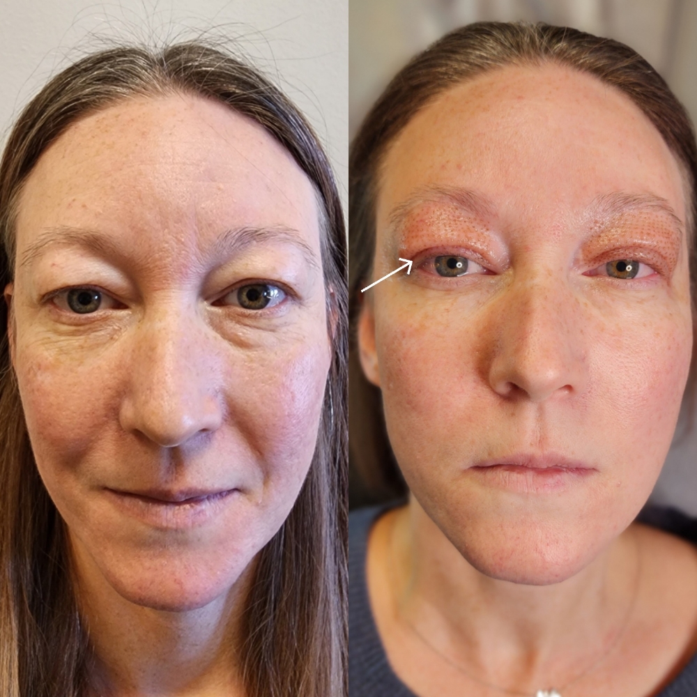 Upper Eyelid Lift