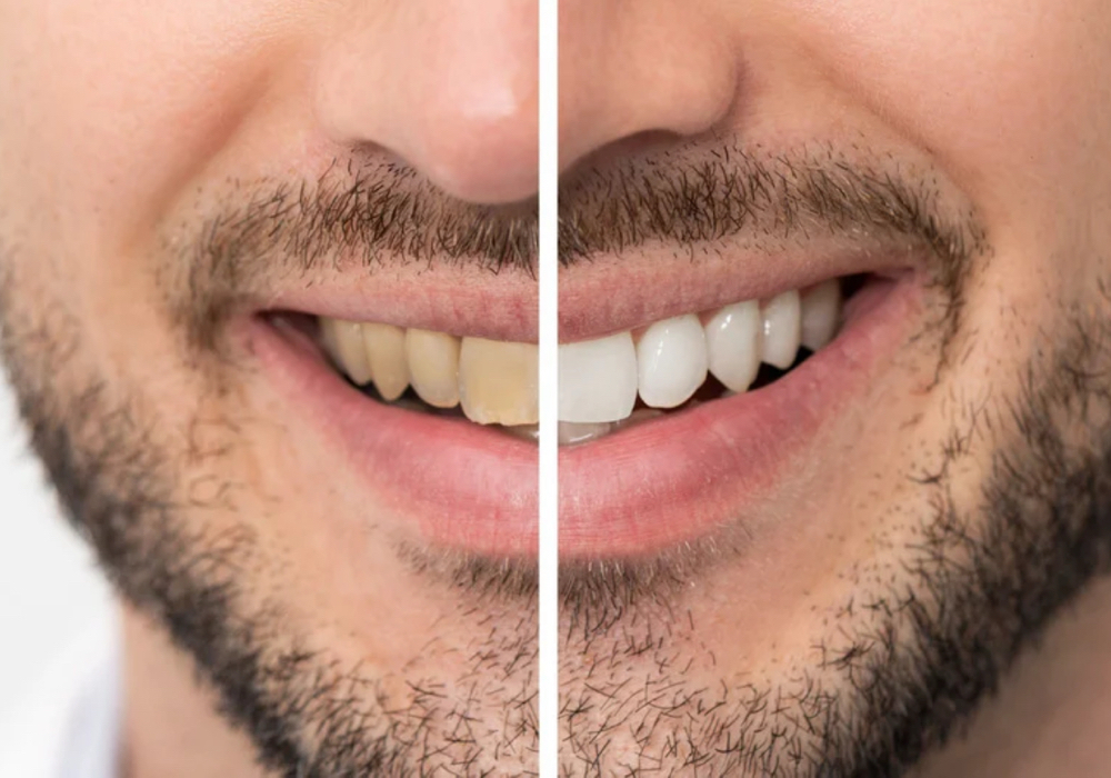 Teeth whitening