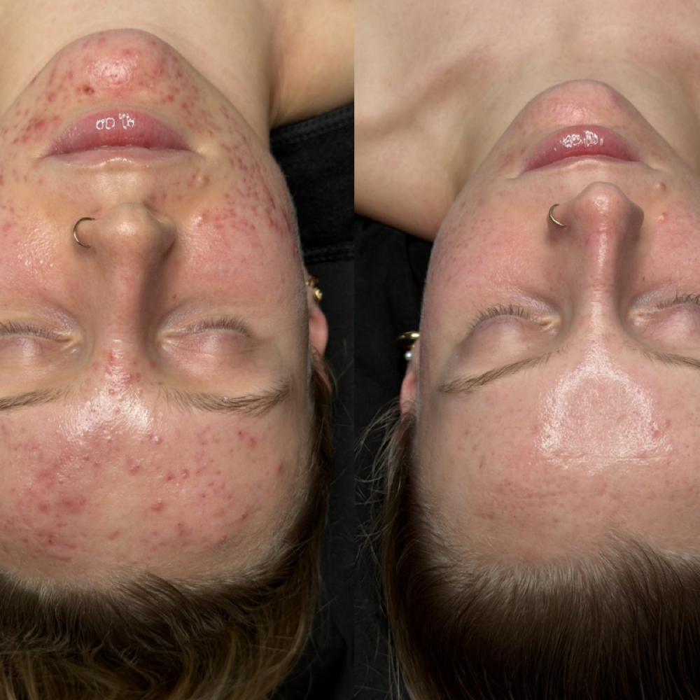New Client: Acne Bootcamp Treatment at Aesthetics by Jenna in Loomis, CA