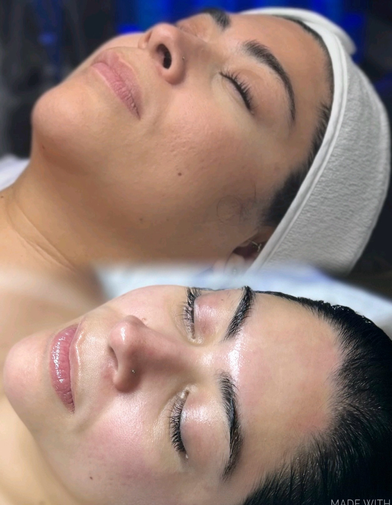 Deluxe hydrafacial