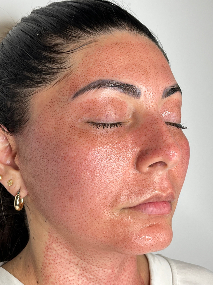 FIBROBLAST FULL FACE /CUELLO