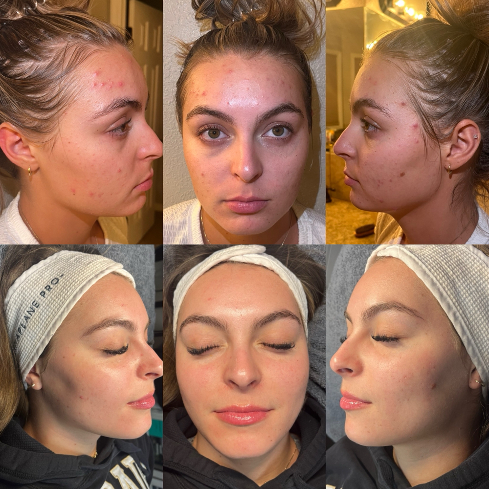 Face Reality Acne Treatment