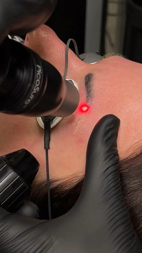Removal Eyebrows/remoção A Laser