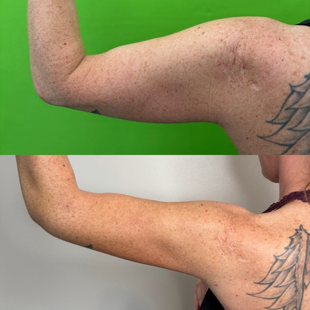 Post-Op Arm/ Leg Bundle at N'Vestd Aesthetics in Fairfeild, OH