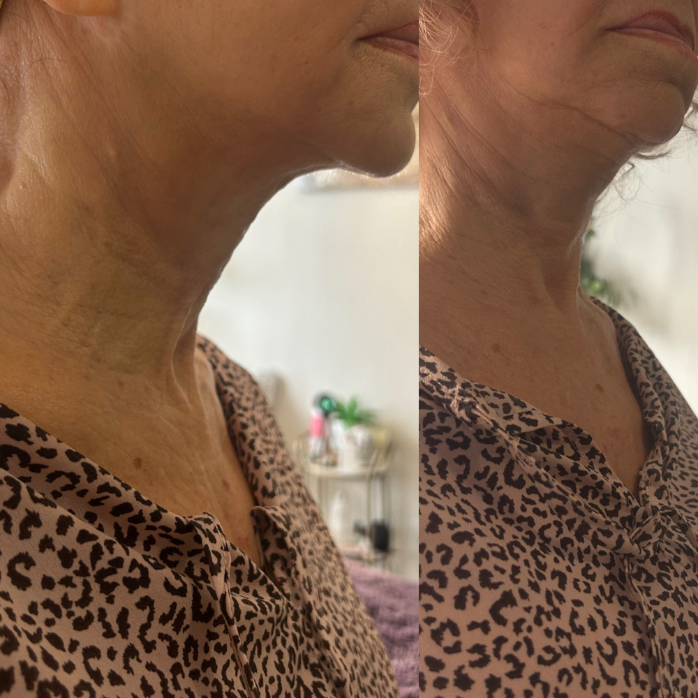 DOUBLE CHIN/TURKEY NECK REDUCTION