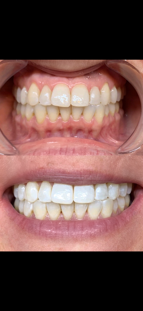 Teeth Whitening- 60 Min