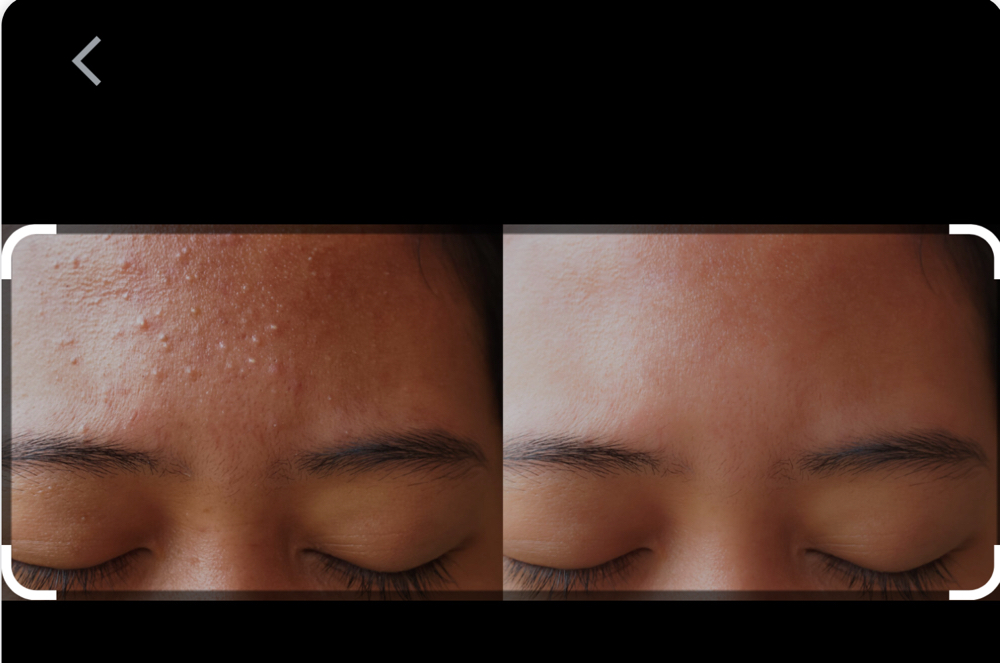 Acne Facial