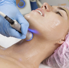6x RF Skin Tightening Partial Face